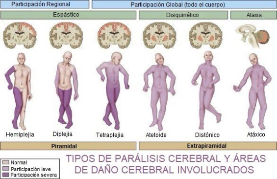 Parálisis Cerebral ¿qué Es Centro Activa Especialistas En Movimiento Ferrol